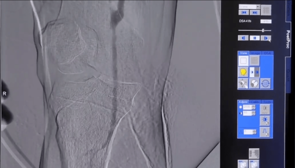 Карбоксіангіографія