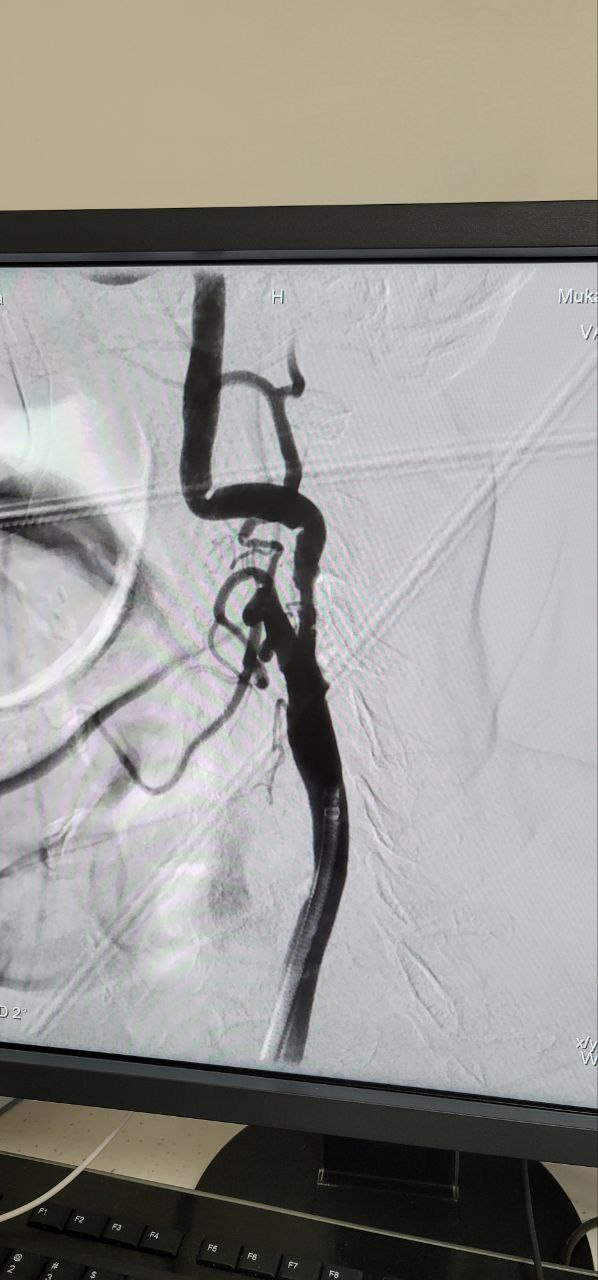 Стентування сонних артерій