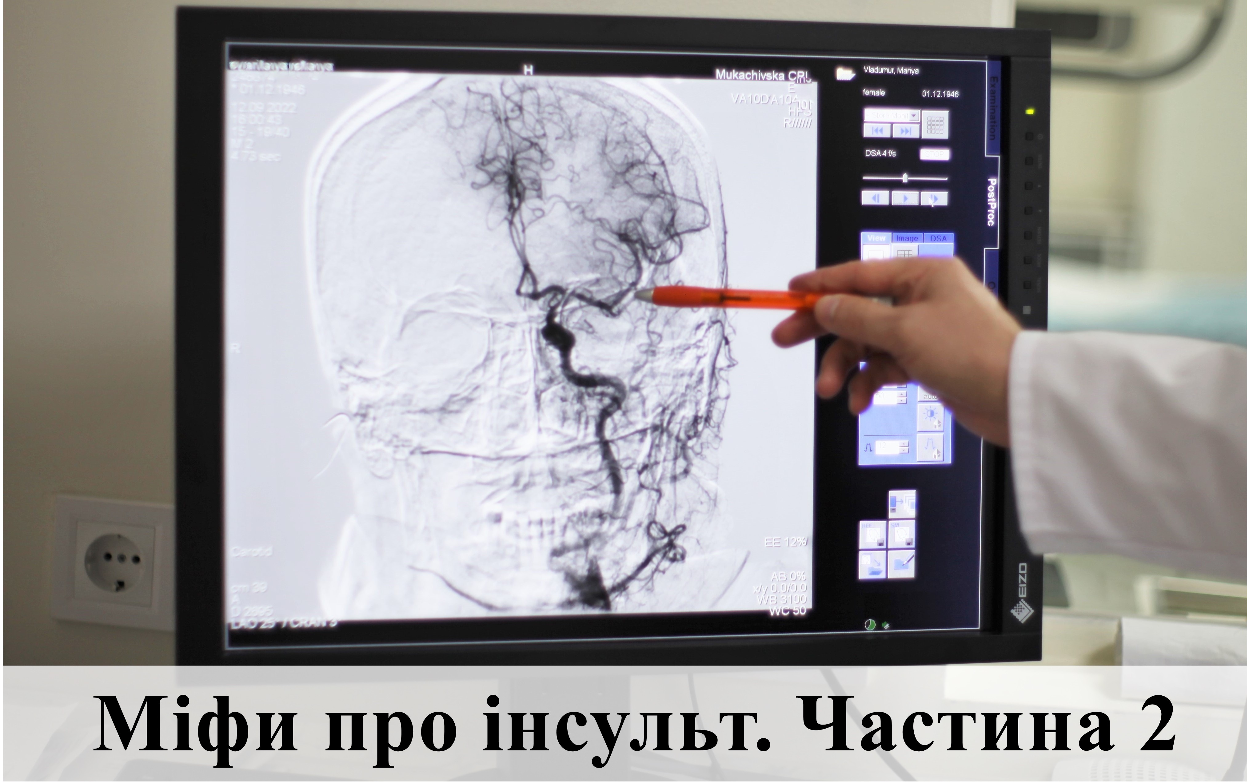 Міфи про інсульт. Частина 2