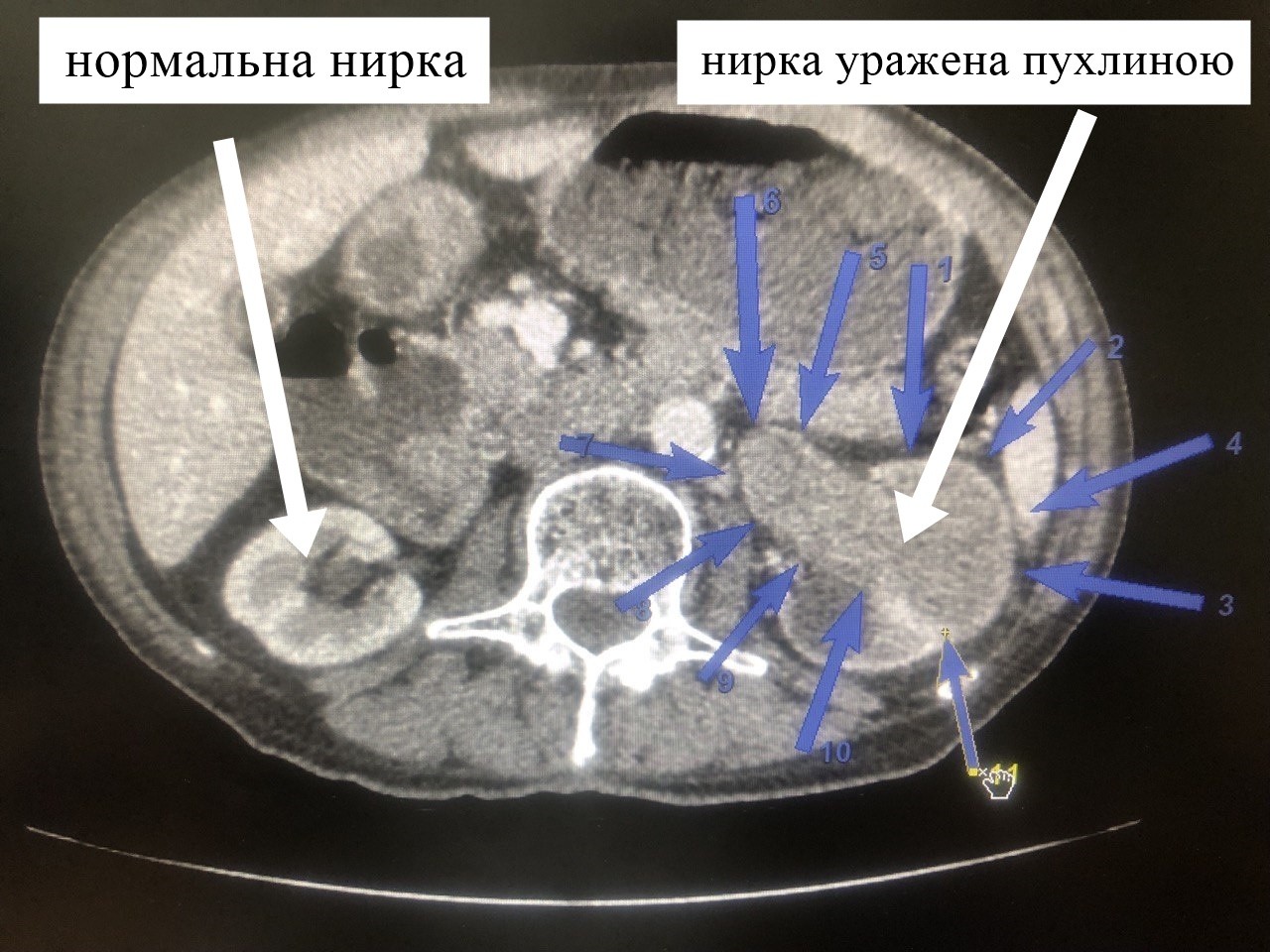 Сьогодні, у Всесвітній день нирки, хочемо вам розповісти історію одного пацієнта