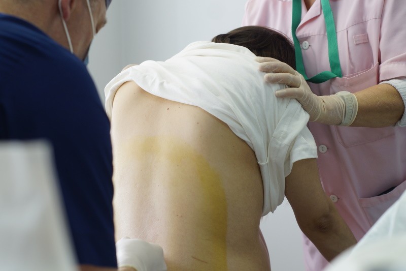 Епідуральна анестезія