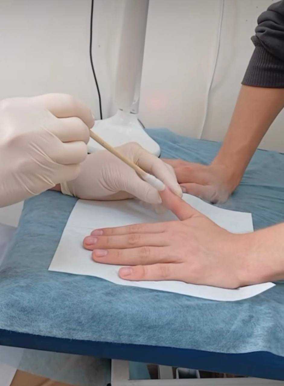 Кріомасаж та кріодеструкція в Лікарні Святого Мартина